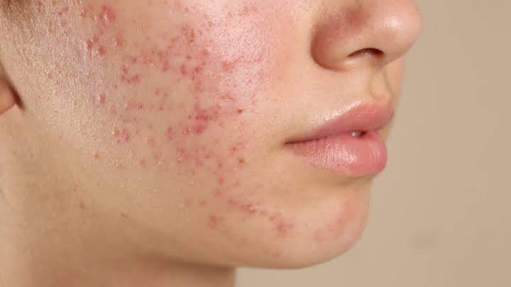 What Causes Acne to Return After Initial Improvement